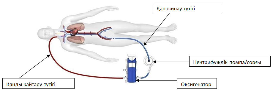 veno-venous ECMO KZ.PNG