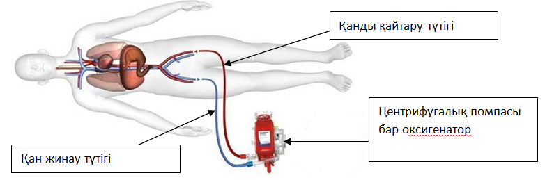 veno- arterial ECMO KZ.PNG