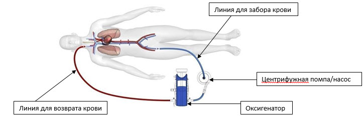Veno-venoznoy ECMO.jpg