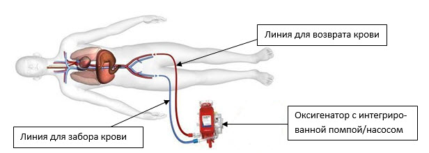 BA ECMO.jpg