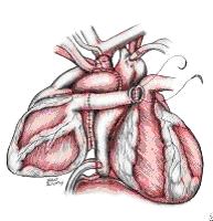 Гетеротопическая пересадка сердца