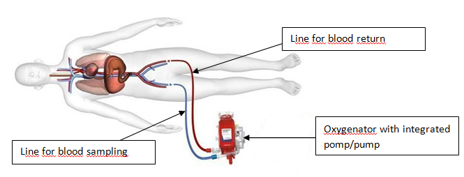 veno- arterial ECMO EN.PNG