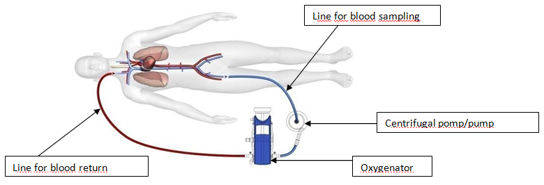 veno-venous ECMO EN.PNG